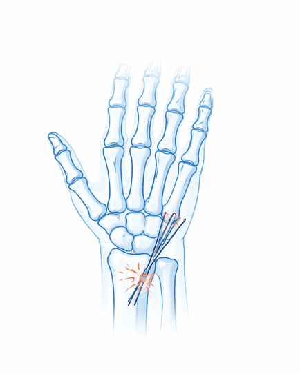 HAND AND UPPER LIMB SURGERY