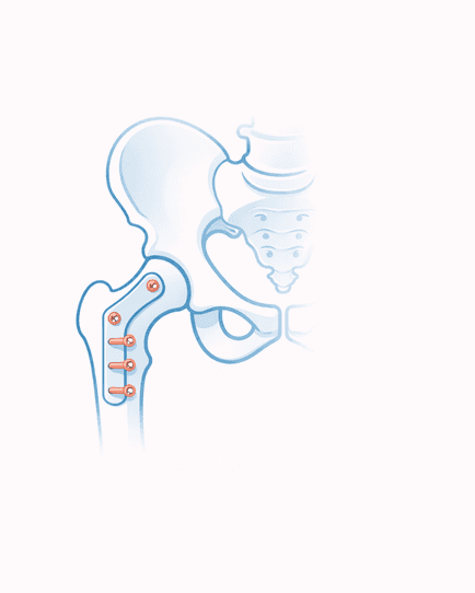 HIP SURGERY